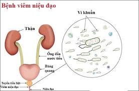 Viêm niệu đạo do lậu - Hình ảnh minh họa